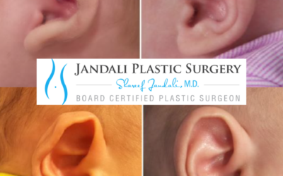 Infant Ear Molding